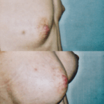 chirurgia estetyczna piersi